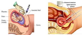 Image result for chorionic villus sampling